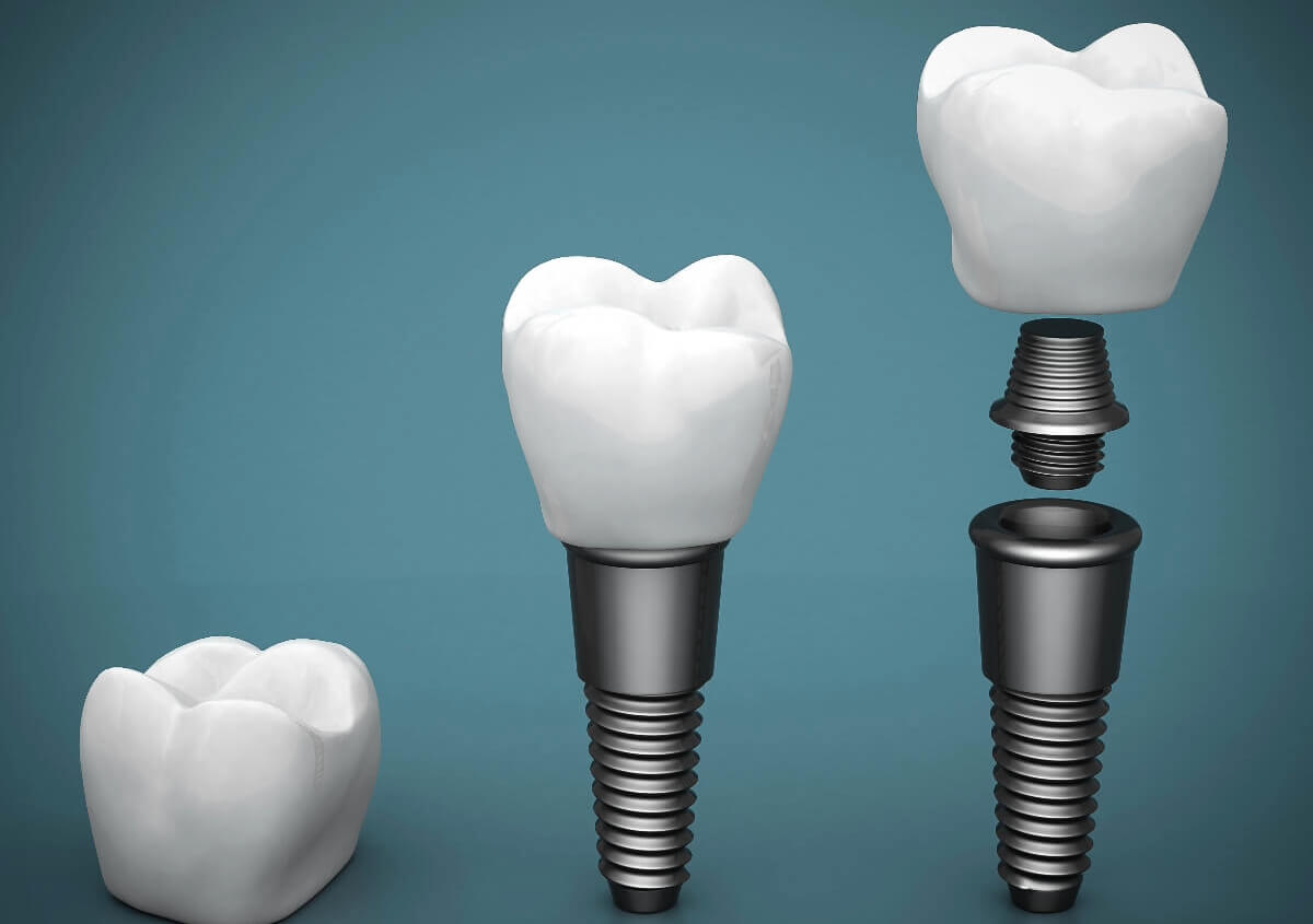 Dental Implants Services in Denver NC area